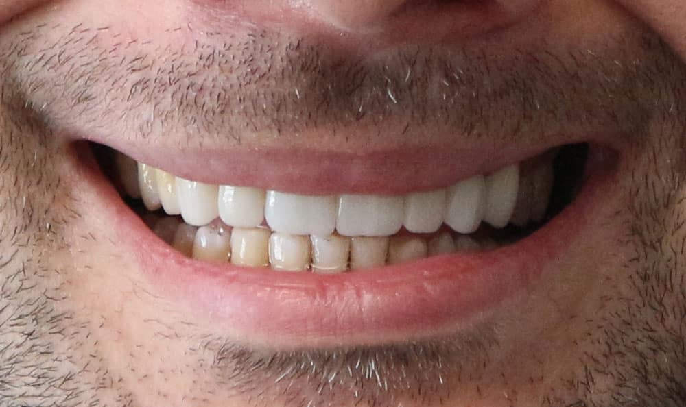 dental implants after